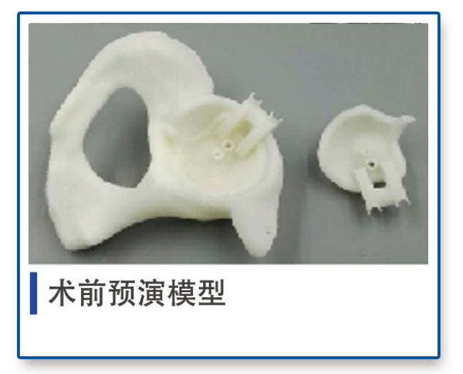 术前预演模型